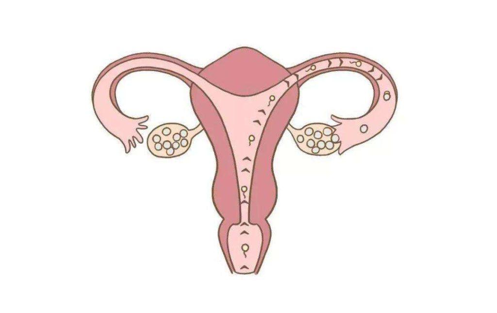 单侧卵巢能否做试管婴儿？