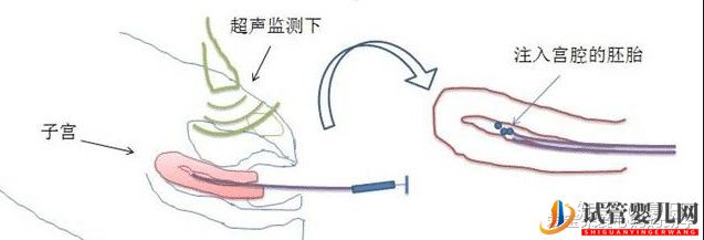 试管婴儿网:试管移植的具体步骤全解析(图1)