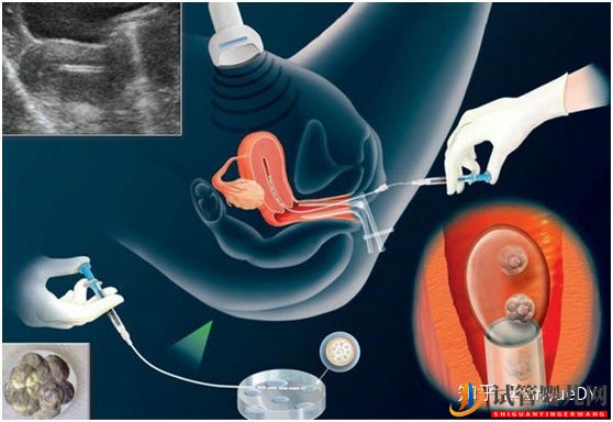 试管婴儿网:冻胚移植的流程概述_子宫内膜及身体准备非常重要(图4)