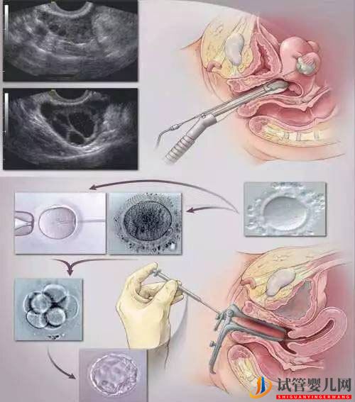 试管婴儿网:试管移植几个胚胎更易着床(图2)