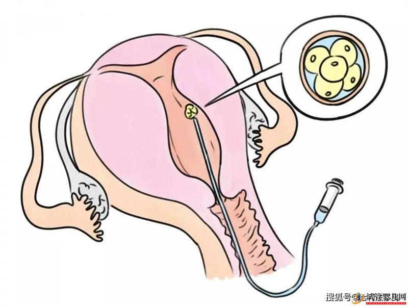 试管婴儿网:试管胚胎不是你想移植就能移，需要满足这些条件！(图1)