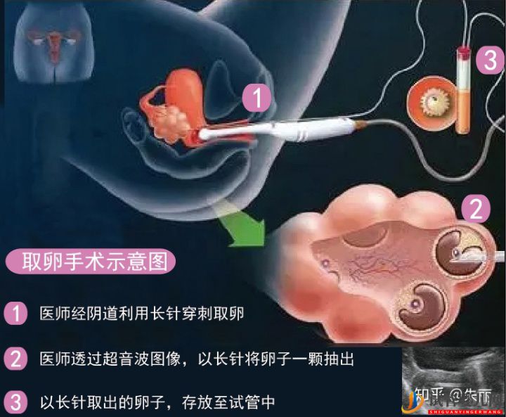 试管婴儿网:“取卵”手术全过程揭秘(图1)