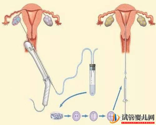 试管婴儿的一个基本流程和周期时间(图3)