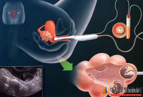 试管婴儿过程中的取卵手术真的很痛吗_看完你就安心了(图3)