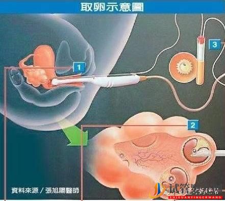 试管婴儿是怎么做的_一分钟带你看懂全过程_难孕女(图13)