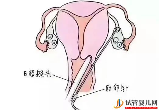 一文读懂试管婴儿全过程(图9)