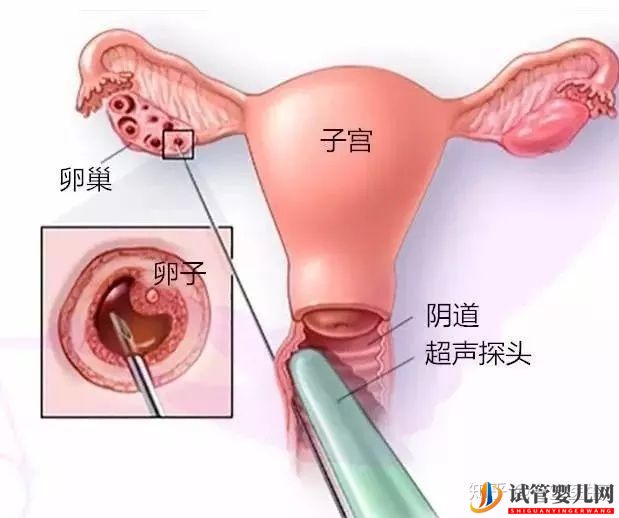 取卵真的特别疼吗(图10)