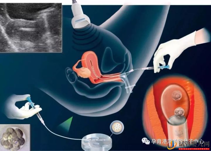 试管婴儿技术,美国vs中国(图6)