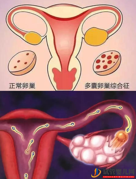 多囊卵巢综合症做试管婴儿要注意什么？(图1)