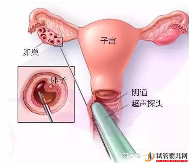 试管的时候,取卵痛吗(图2)