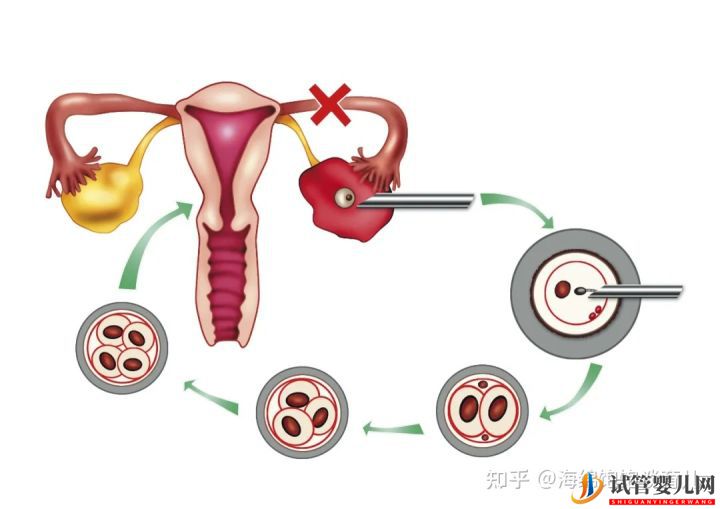 试管婴儿1代、2代、3代、4代哪个最好_真实操作过(图4)