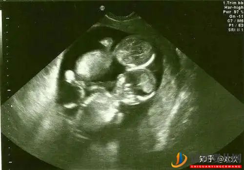 试管婴儿网:多年不孕,深圳三代试管一次成功双胎男宝(图3)