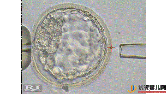 试管婴儿网:国内外三代试管,技术成熟安全吗(图3)