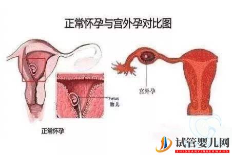 试管婴儿网:做试管婴儿宫外孕会发生吗？做试管婴儿能不能避免宫外孕(图3)