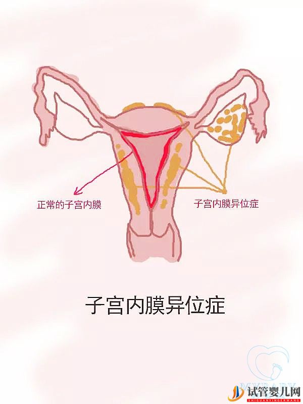 试管婴儿网:子宫内膜异位症试管婴儿成功率高吗？(图1)