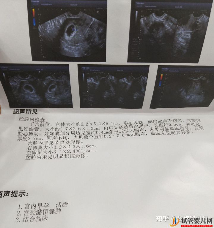 试管婴儿网:40岁卵巢早衰150斤,移植一次成功,怎么做到的(图2)