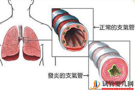 试管婴儿网:四川哪家医院治疗慢性支气管炎效果好(图1)