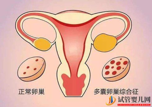 试管婴儿网:试管取卵后怎么解决卵巢过度刺激综合症(图1)