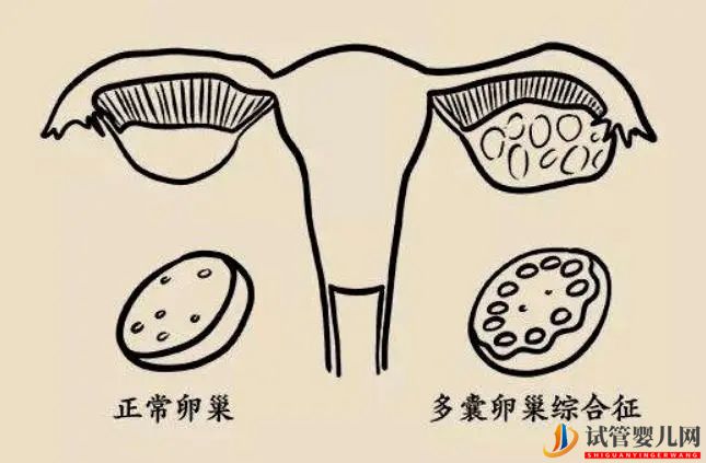 试管婴儿网:造成多囊卵巢的原因有哪些(图1)