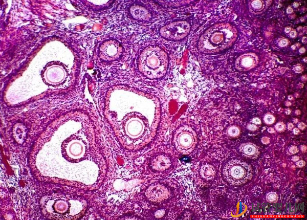 21个基础卵泡是多囊卵巢