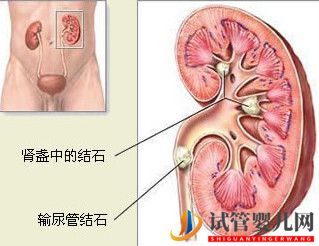 治疗肾结石的费用大概需要多少钱？(图2)