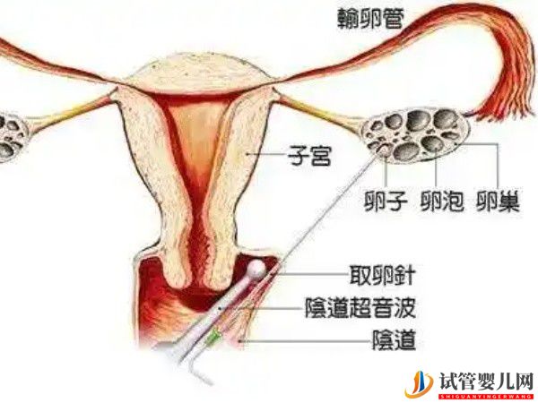 双腔取卵针费用在200-700元左右