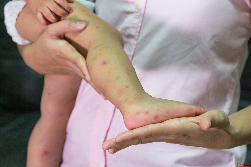 婴儿湿疹和痤疮有什么区别？(试管婴儿费用大概要多少钱)(图3)