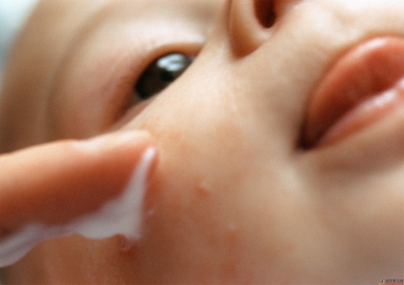 婴儿湿疹和痤疮有什么区别？(试管婴儿费用大概要多少钱)(图2)