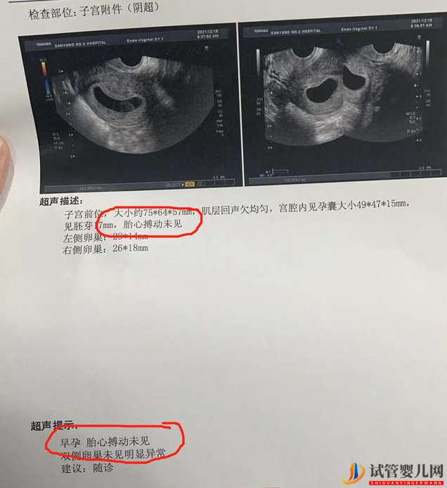 做试管婴儿可以避免胎停吗？(试管婴儿费用大概要多少钱)(图2)