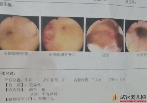 有不孕情况时就可查宫腔镜