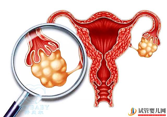 卵巢功能差能做试管婴儿吗？单侧卵巢能做试管婴儿吗(多囊卵巢能怀上孩子吗)(图1)