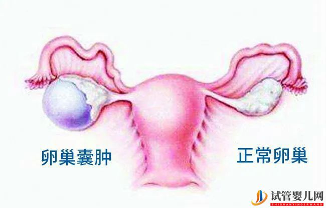 有卵巢囊肿可以做试管婴儿吗？(多囊卵巢能怀上孩子吗)(图2)