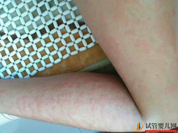 荨麻疹是一种皮肤病