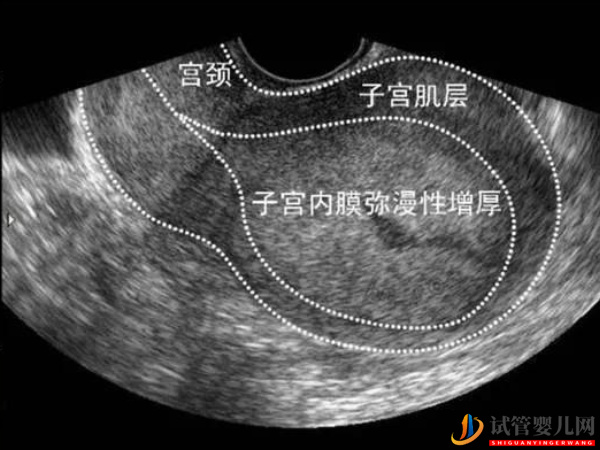 amh0.34是卵巢早衰