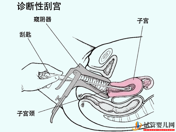 有些患者在移植前就需要刮宫