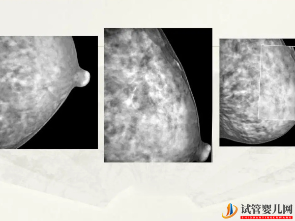 乳腺B超可检查乳腺的疾病
