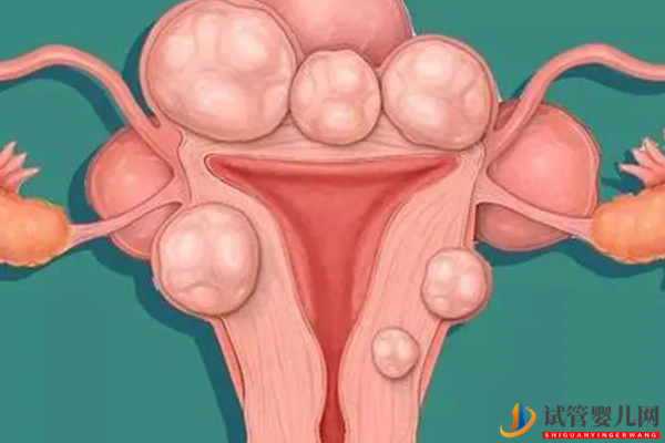 子宫肌瘤试管前需要治疗