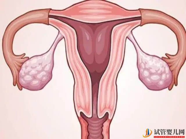 子宫肌瘤做试管婴儿会影响成功率
