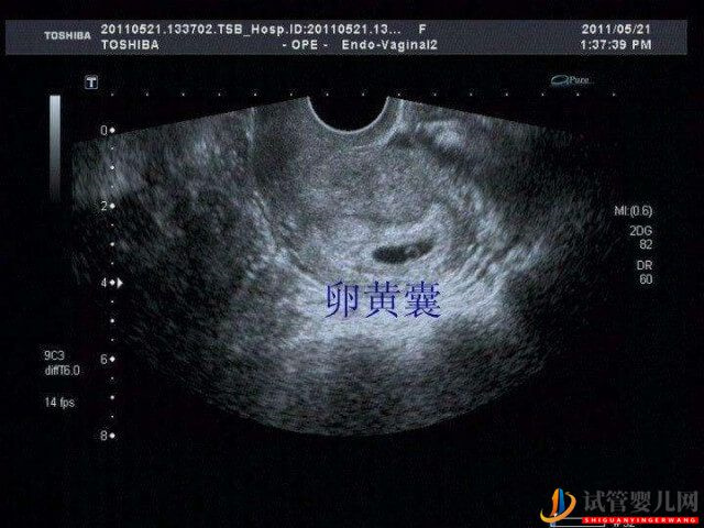 试管移植怀孕后卵黄囊在20-25天会出现