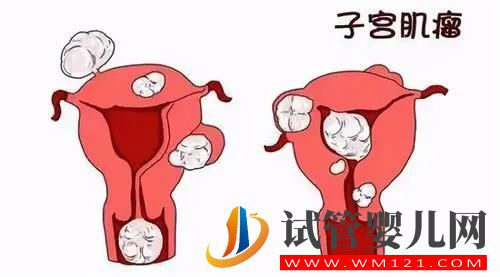 什么是子宫肌瘤?(图1) 什么是子宫肌瘤?(图1)