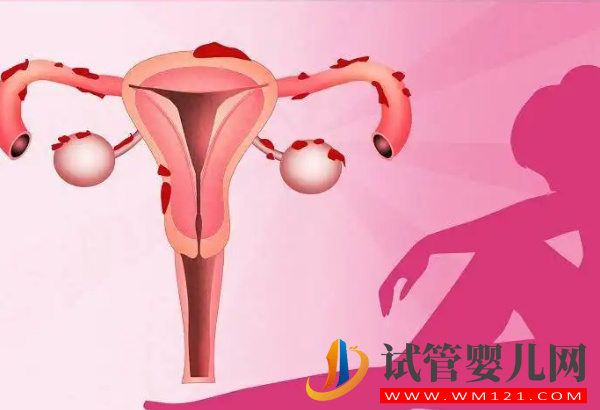 子宫内膜异位症是可以做试管的