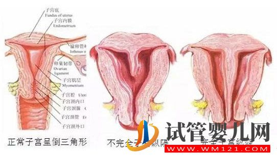 纵隔子宫有2种不同类型