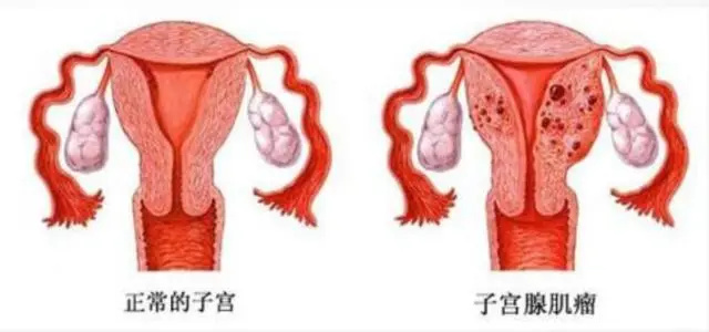 我有子宫肌瘤还能进行试管婴儿备孕吗?(图1)