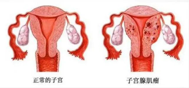 我有子宫肌瘤还能进行试管婴儿备孕吗?(图1) 我有子宫肌瘤还能进行试管婴儿备孕吗?(图1)