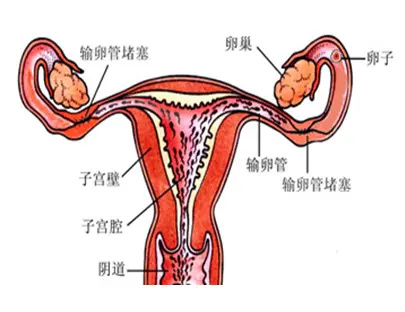 输卵管堵塞的原因是什么，能彻底根治吗？(图1)