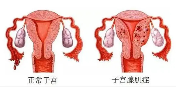 子宫腺肌症能去跟吗？有效的治疗方案大全(图1)
