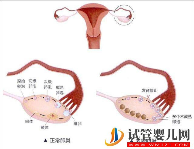 多囊卵巢综合征