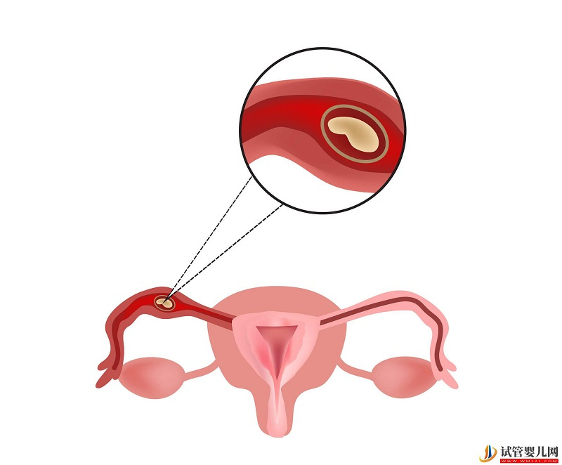 子宫内膜息肉会癌变吗？子宫肌肉引发癌变会有什么原因？(图1)