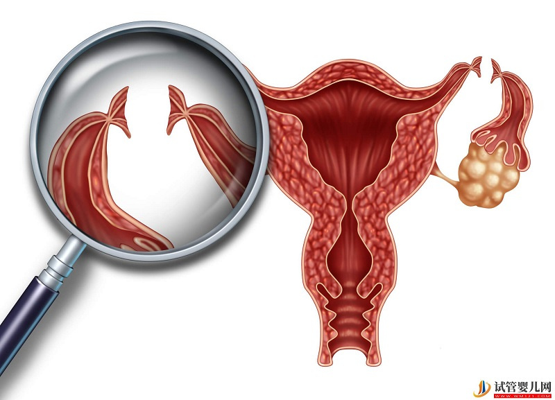 子宫内膜息肉的症状是什么？子宫内膜息肉有哪些表现？(图1)