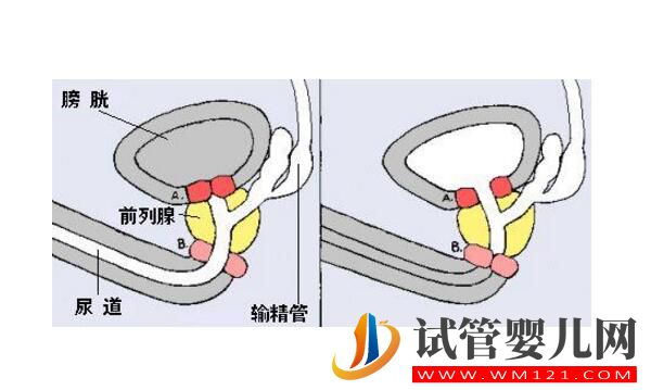 逆行射精可以做试管婴儿吗？这篇全部讲清楚！听医生怎么说!